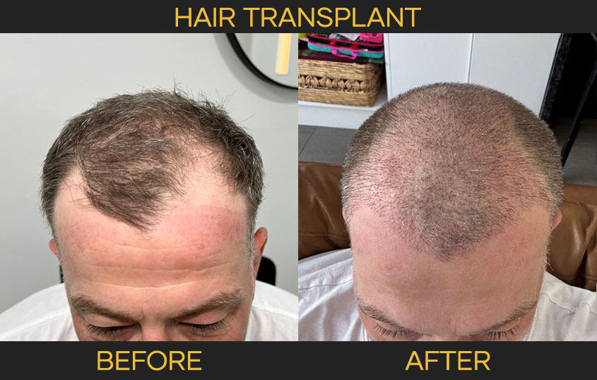 hairtransplant-01