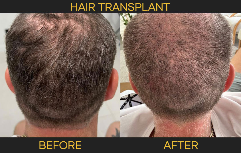 hairtransplant-02
