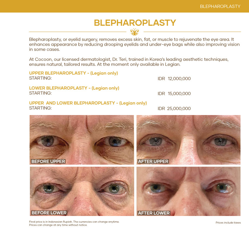 Blepharoplasty