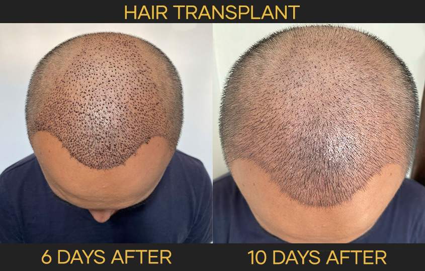 hair transplant before after