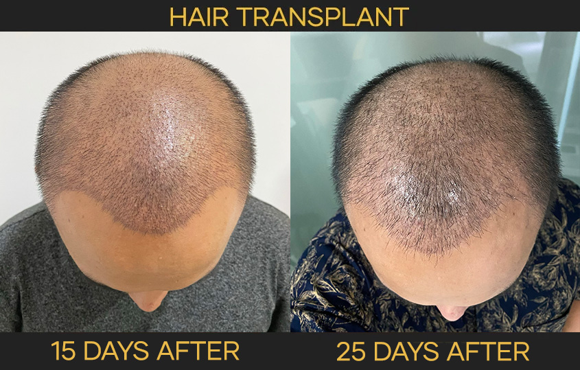 Process of FUE hair transplant, Bali