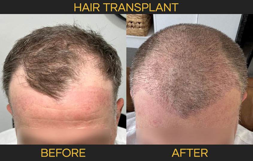 FUE hair transplant results for male pattern baldness, Cocoon Medical Spa Bali