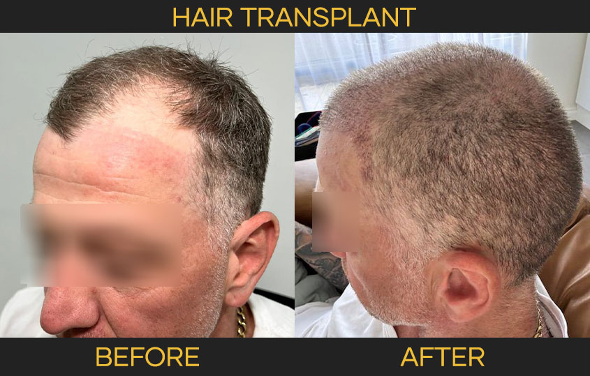 Result of FUE Hair Transplat Bali