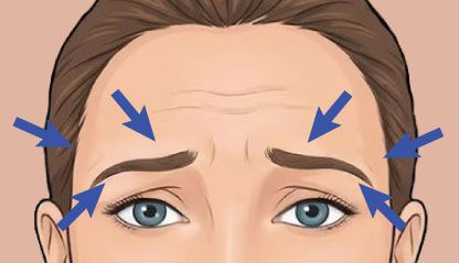 Browlift Botox for Wrinkles Bali