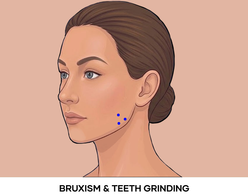 Illustration of Bruxism Teeth Grinding botox points - Masseter
