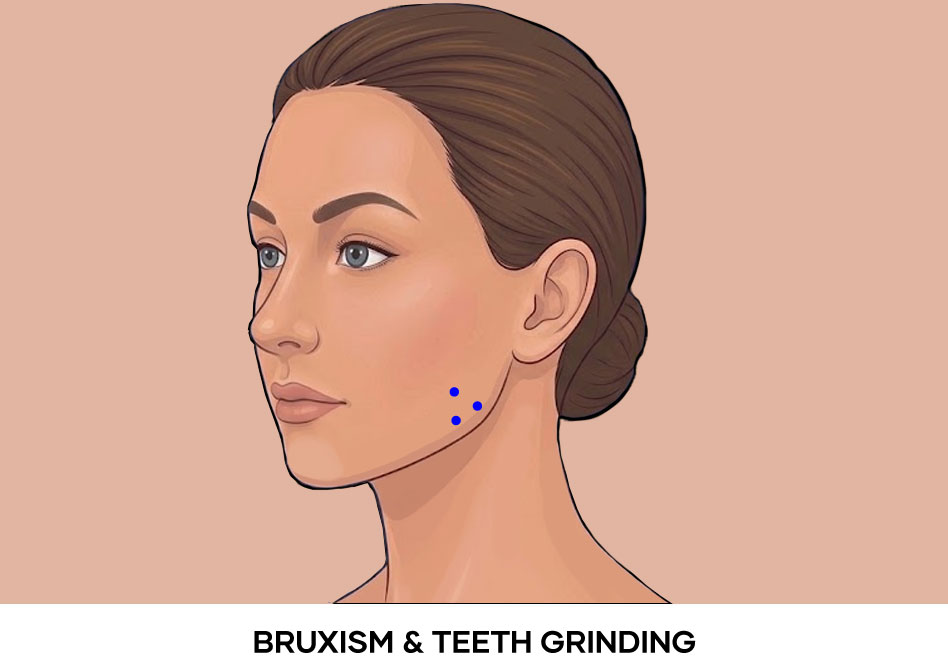 Illustration of Bruxism Teeth Grinding botox points - Masseter Illustration of Bruxism Teeth Grinding botox points - Masseter