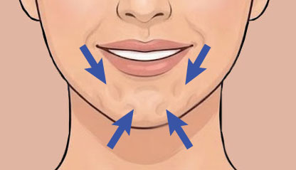 Illustration Chin Dimpling Botox
