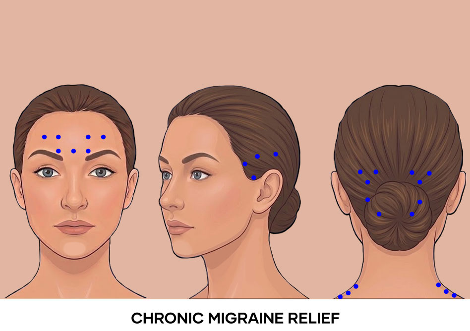 Illustration of Chronic Migraine Relief points Bali Botox Illustration of Chronic Migraine Relief points Bali Botox