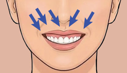 Illustration of Gummy Smile