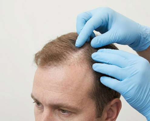 FUE hair transplant Cocoon Medical Spa