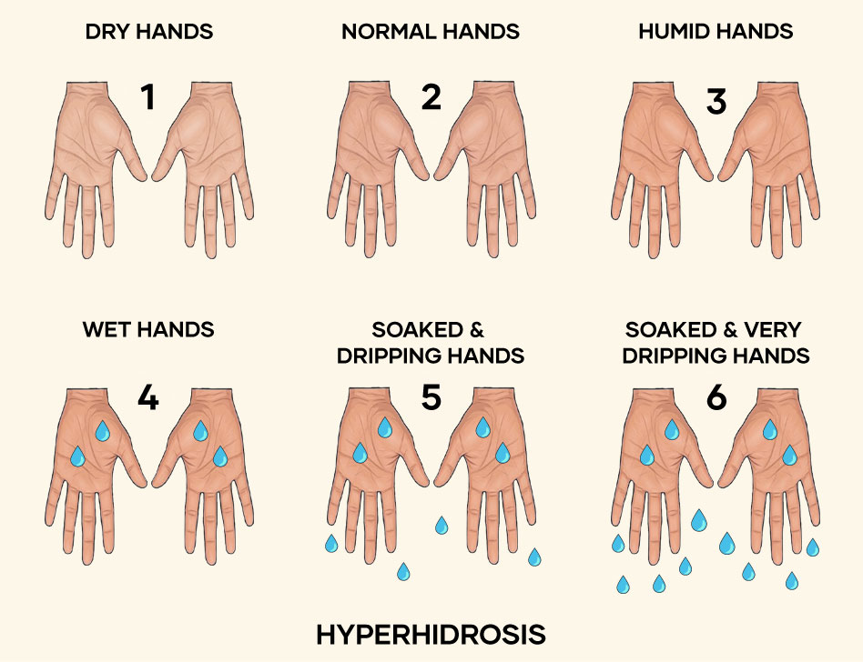 Hyperhidrosis-illustration