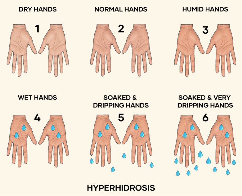Illustration of Hyperhidrosis - exsesive sweating Illustration of Hyperhidrosis - exsesive sweating