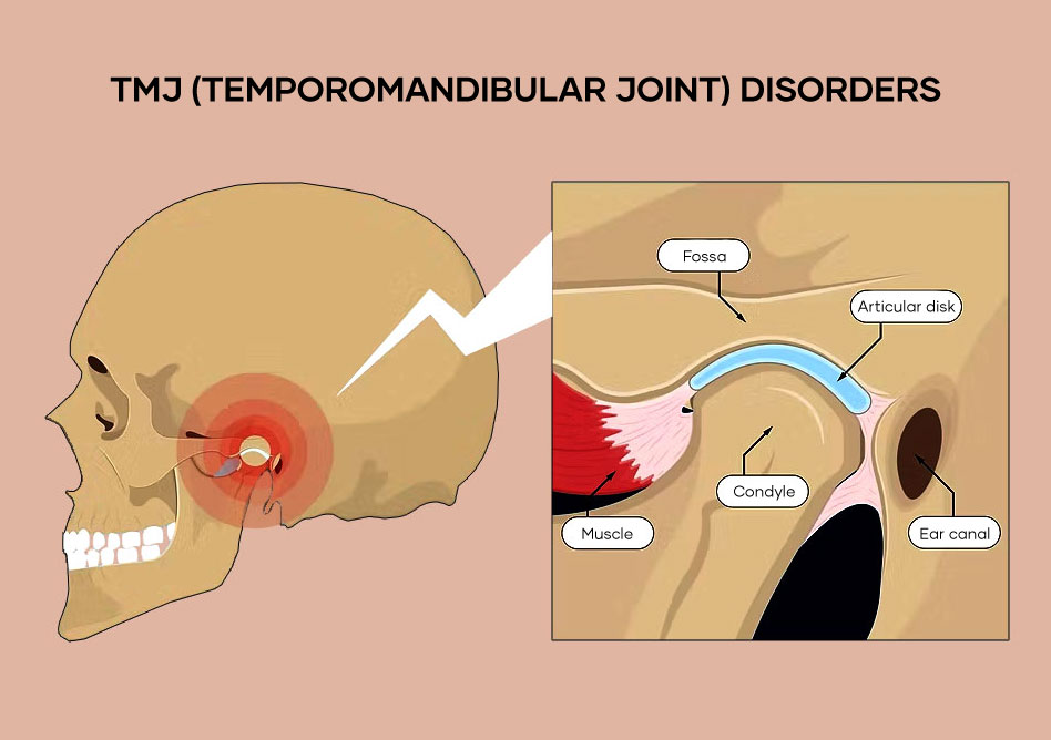 Illustration-TMJ-disorder