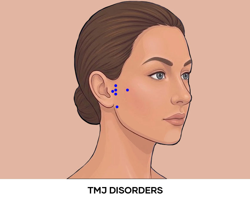 Illustration of TMJ Disorders Botox points