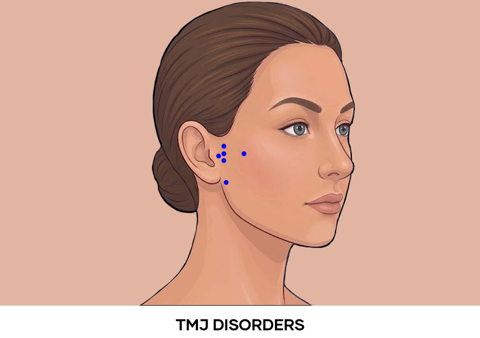 Illustration of TMJ Disorders Botox points Illustration of TMJ Disorders Botox points