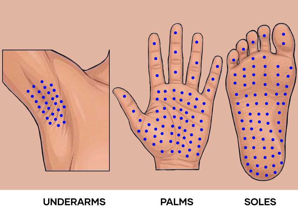 UnderarmsPalmsSoles