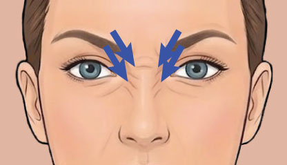 Bunny lines Botox illustration
