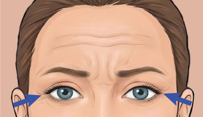Crows Feet Botox illustration