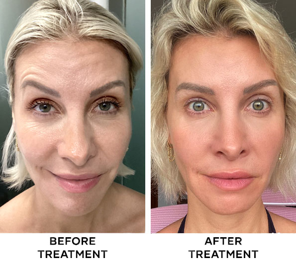 forehead-botox-results-bali-01