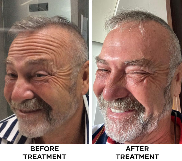 forehead-botox-results-bali-05