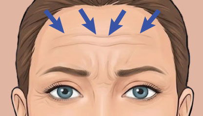 Illustration Forehead lines Botox for Wrinkles Bali