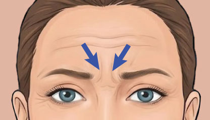 Frown lines Botox illustration
