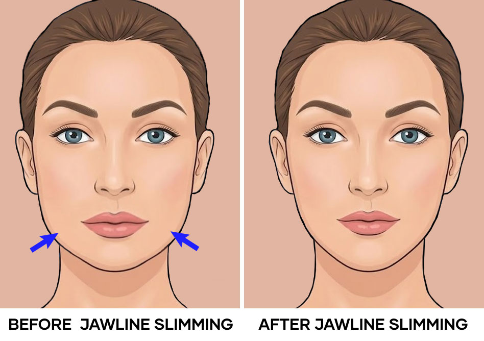 Illustration of before and after Jawline slimming