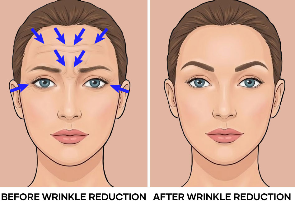 Illustration before after wrinkle reduction Illustration before after wrinkle reduction