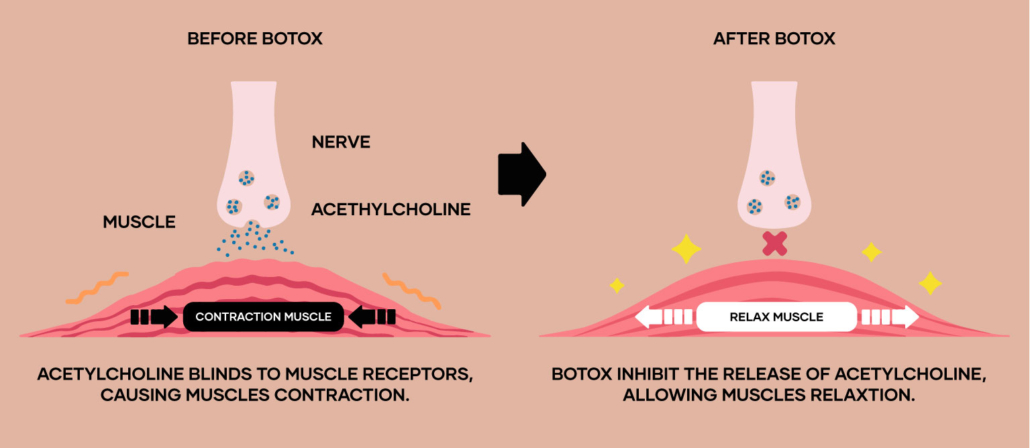 Illustration of a muscle before after Botox injection Illustration of a muscle before after Botox injection