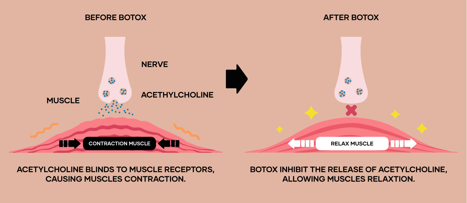 Illustration of a muscle before after Botox injection
