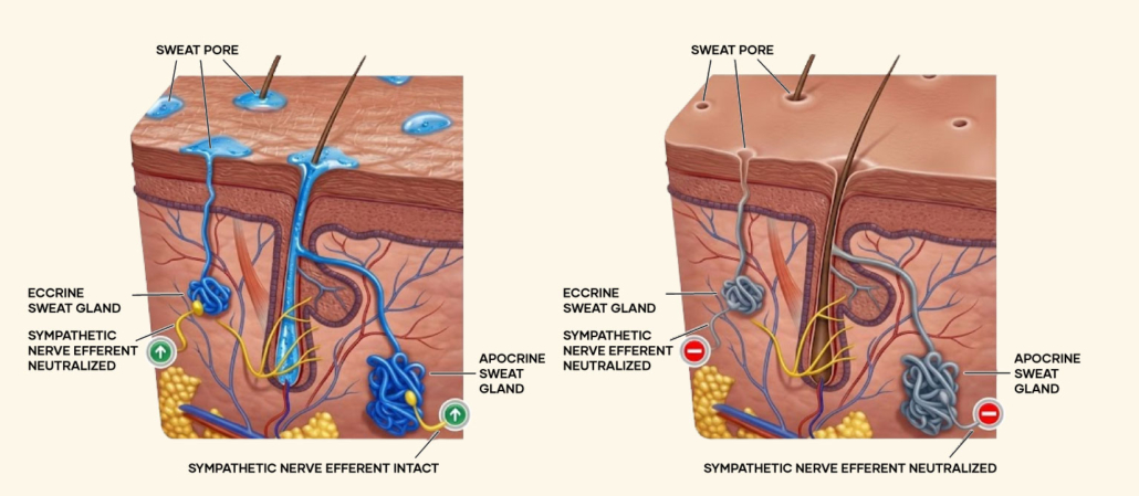 illustration sweat gland before after botox illustration sweat gland before after botox