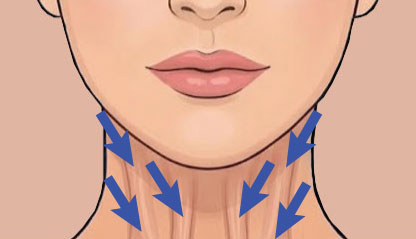 Neck Bands Botox Illustration